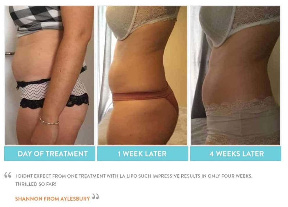 before, Cryolipolysis Hungerford