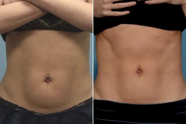 body sculpting FAQs Hungerford