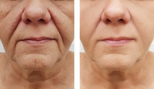 Learn more about Morpheus8 Treatment Hungerford today!