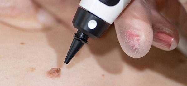 After Skin Tag Removal Hungerford