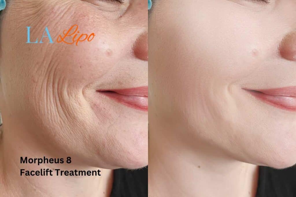 Morpheus8 Treatment Hungerford for flawless skin! Call us today!