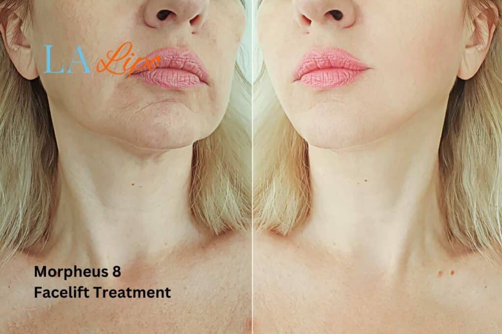 Turn back time with Morpheus8 Treatment Hungerford