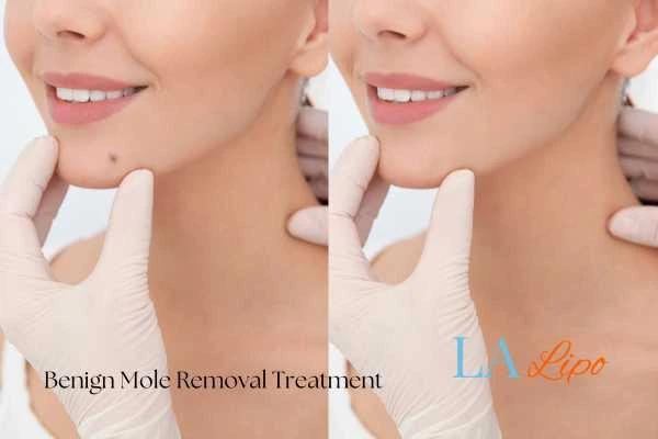 woman's before and after mole removal Hungerford results