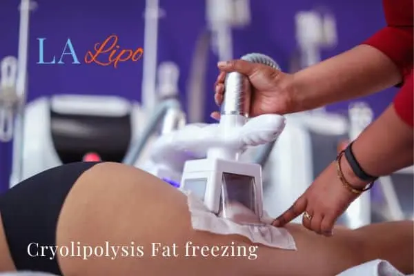women getting fat freezing Hungerford