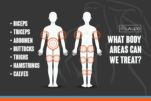 Graphic to show areas you can have LA-EMS Body Sculpting Hungerford treatment.