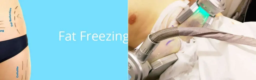 multi areas of a persons body having coolsculpting Hungerford treatment