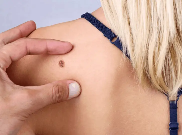 woman having mole removal Hungerford consultation before treatment.