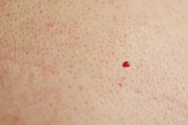 close up of a cherry angioma Hungerford