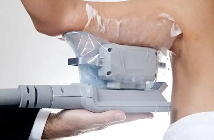 Picture of fat freezing Hungerford on the upper arms.