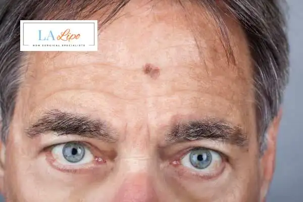 Solar Lentigo Removal Hungerford image of man with mark on his forehead