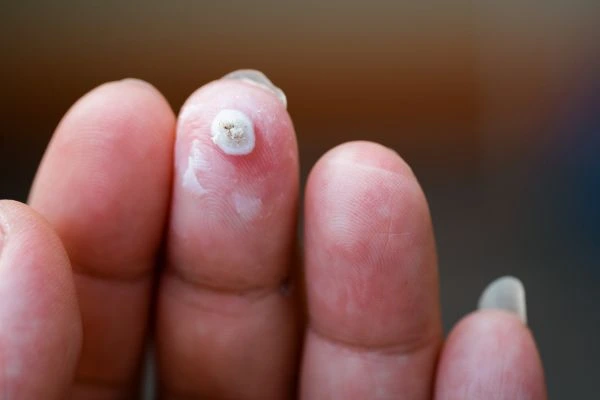 wart on person finger - cryotherapy to treat from LA LIPO Hungerford