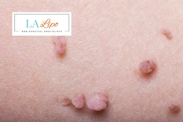 Does cryopen skin tag removal Hungerford hurt? Find out now call our team today!