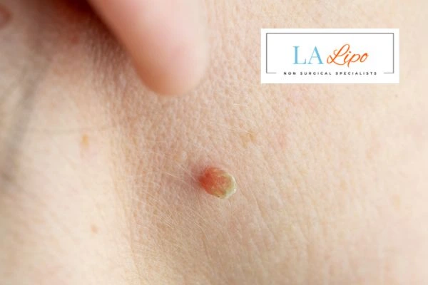 Book skin tag removal Hungerford today speak to our team now!