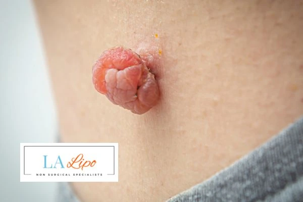 Interested in skin tag removal Hungerford? Concerned about the pain? Find out more today!