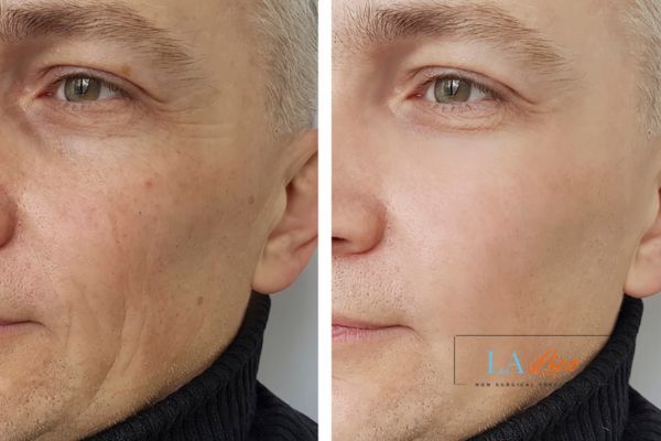 See the amazing results of Morpheus8 Treatment Hungerford!