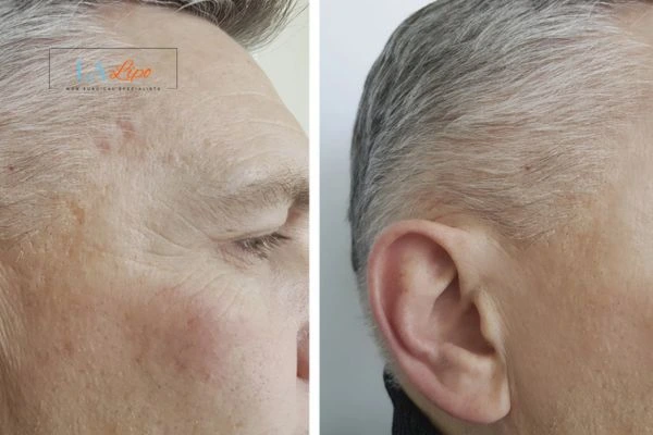 Mens Before & After Morpheus 8 Results Hungerford