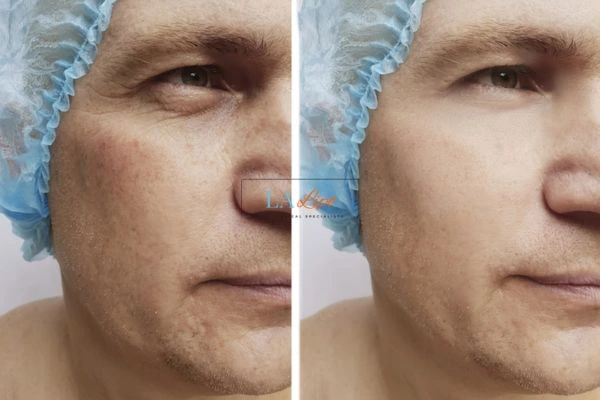 Before and after Morpheus 8 Results Hungerford