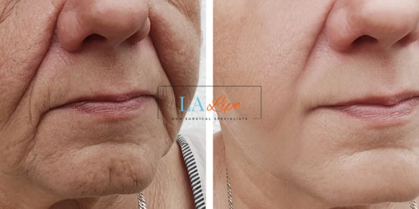 Older lady deeper wrinkle reduction - LA LIPO Morpheus 8 Results Hungerford