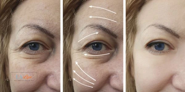 Amazing eye lift Morpheus 8 results Hungerford