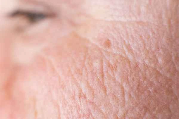 close up picture of a woman's face showing an age spot Hungerford