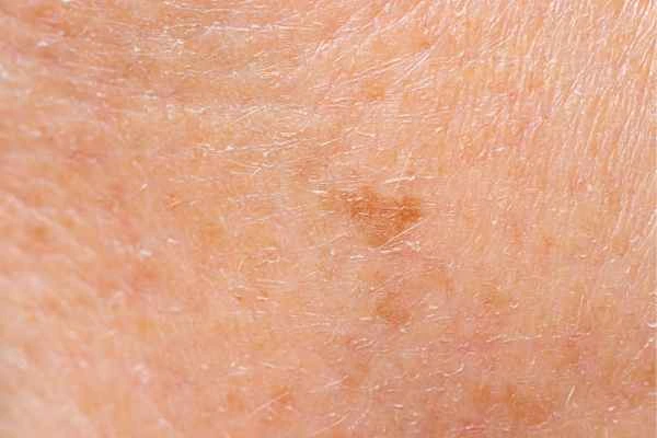 close up picture of age spots Hungerford