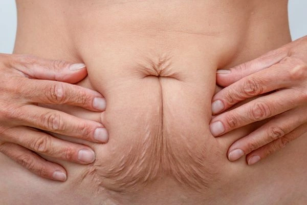 Image of a woman's stomach with loose skin - example of skin tightening Hungerford options