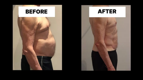 What Symptoms Can Diastasis Recti Cause in Men? Weak Core, Back Pain and Poor Posture Hungerford